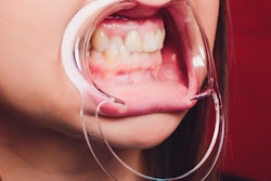 2021 04 08 20 43 4043 Dental Mouth Retractor Gag 400