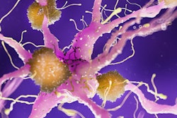 2021 04 09 20 18 8172 Amyloid Plaque Alzheimer2 400
