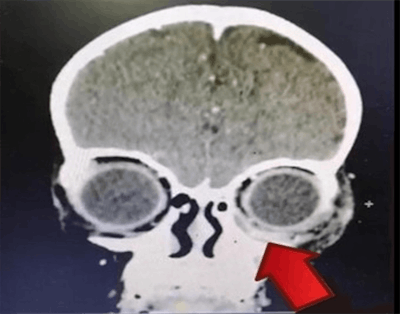 The arrow indicates the periosteal abscess collection extending into the inferomedial aspect of the left orbit. All images courtesy of Satar et al. Licensed under CC BY-NC 4.0.