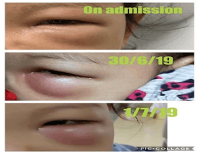 The progression of the swelling, which worsened on the third day after admission, of the girl's left eye.