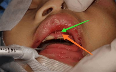 The orange arrow indicates the gum swelling and the green arrow indicates the abscess collection.