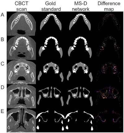 A CBCT scan and segmentation from one patient. The false negatives and false positives for the teeth and jaw are colored in the difference map. Image courtesy of Wang et al (2021), 'Multiclass CBCT Image Segmentation for Orthodontics with Deep Learning,' J Dent Res.