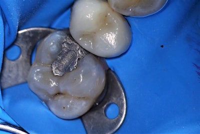 The patient presented with a leaky filling and recurrent decay on tooth #14. All images courtesy of Dr. Jorge Zapata.