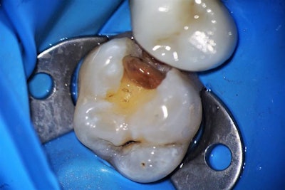 Preparation of tooth #14 after amalgam and decay removal.