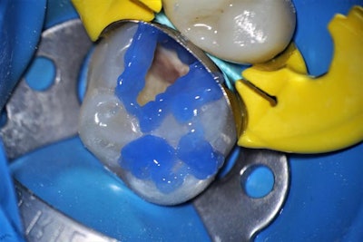 Selective etch of uncut enamel surfaces of the preparation.