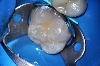 Finalized restoration prior to polishing and finishing.