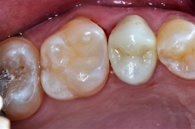 Finalized restoration prior to polishing and finishing.