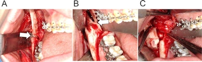 Intraoperative view of the patient's mouth. (A, B) The white arrow points to the severed inferior alveolar nerve (IAN). (C) The nerve was removed from the mandibular foramen. All images courtesy of Kasahara et al. Licensed under CC BY-NC 4.0.