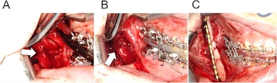 Intraoperative view after nerve repair. (A) The white arrow points to the three 7-0 polyglycolic acid sutures. (B) The white arrow points to the polyglycolic acid mesh sheet used to protect the repaired nerve. (C) A monocortical titanium plate with five screws was used for the repair.