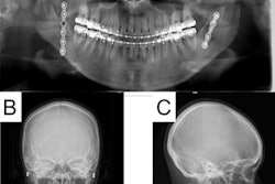 2021 05 11 22 22 1225 2021 05 12 Jaw Surgery3 Lg 20210511221750
