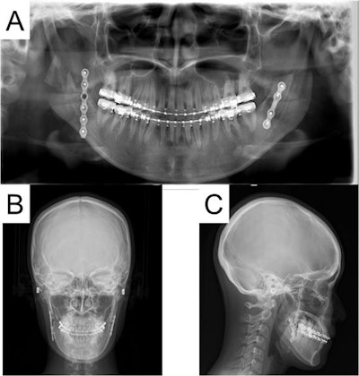 Postoperative radiographs of the patient showed no abnormalities.