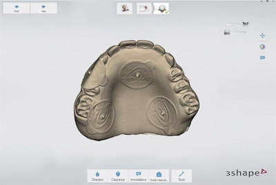 Digitalized maxillary interim complete denture from an intraoral scan. All images published in the Journal of Prosthetic Dentistry, April 28, 2021, Amirali Zandinejad, Hui Liang, Nicole A. Fisher, Cosio, Marta Revilla-León, 'Fabrication of a complete-arch implant-supported fixed interim prosthesis by using a cone beam computed tomography digital scan for a patient with primordial dwarfism: A dental technique,' Copyright Elsevier 2021.