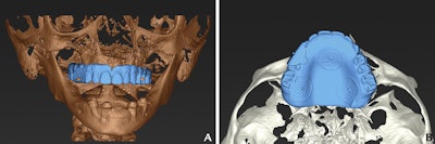 CBCT scan aligned with maxillary interim complete denture in (A) frontal view and (B) occlusal view.