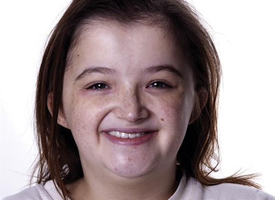 Patient's smile while wearing her new maxillary implant-supported interim prosthesis.