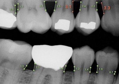 Overjet's Dental Assist software measures bone levels in millimeters. Image courtesy of Overjet.