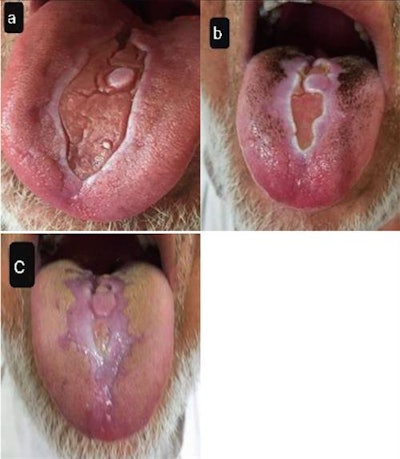 (A) Fissured tongue with white scars immediately after COVID-19 recovery. (B, C) Tongue appearance four weeks after first examination. Image courtesy of BMC Oral Health and Nejabi et al. Licensed under CC by 4.0.