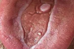 2021 05 25 23 29 6674 2021 05 26 Bmc Oral Health Tongue Ulcer 400