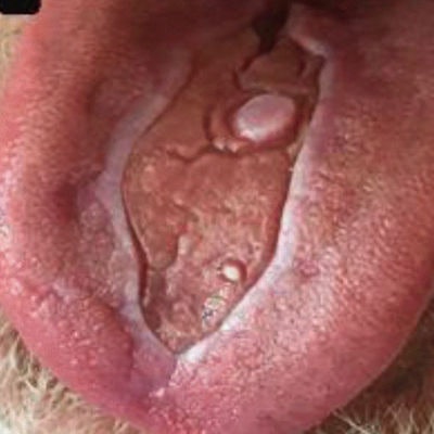2021 05 25 23 29 6674 2021 05 26 Bmc Oral Health Tongue Ulcer 400