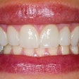 2016 09 13 10 25 03 345 Teeth Veneers 400