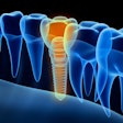2020 06 23 17 58 0104 Implant 3 D 400