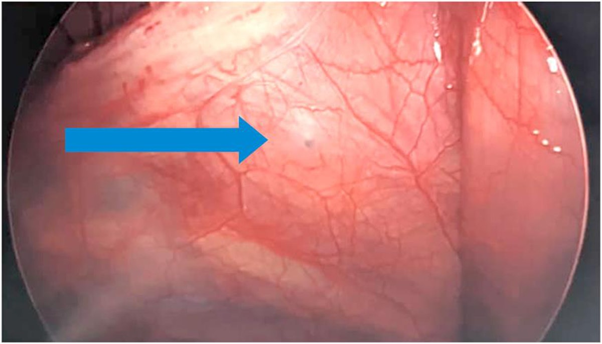 Doctors Removed a Metal Braces Wire That Was in a Woman's Intestines for 10  Years