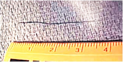 The gray-black, semiflexible orthodontic wire.