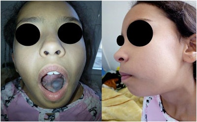 The mucocele of the submandibular gland on the floor of the girl's mouth. All images courtesy of Slimani et al. Licensed under CC BY-NC 4.0.