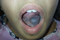 2021 06 17 23 52 7120 2021 06 18 Mucocele1 20210617230727