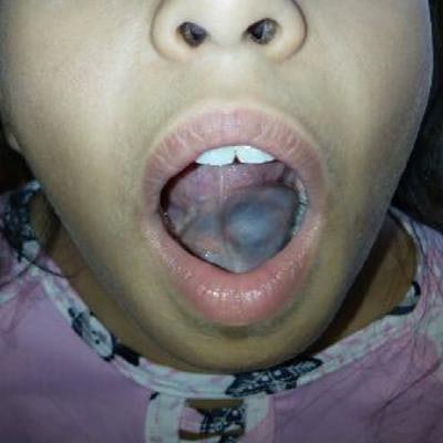 mucocele under tongue
