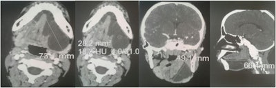 Parenchymal window facial CT scan showing submandibular mucocele.