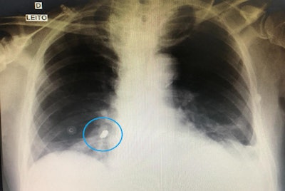 A chest x-ray revealed a foreign body, eventually identified as a dental crown, in a man's right lower lobe bronchus. All images courtesy of Hadad et al. Licensed under CC BY-NC-ND 4.0.