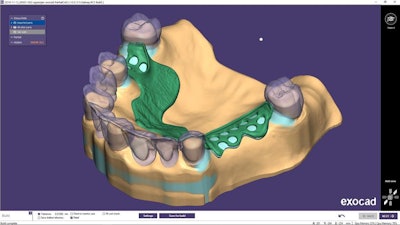 PartialCAD 3.0 Galway used to design removable partial dentures is now available. The release integrates with Exocad's DentalCAD. Image courtesy of Exocad.