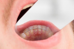 2021 06 25 21 24 3224 Dental Retainer 400