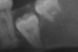 2018 04 17 23 59 6644 X Ray Third Molar 400