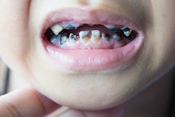 2020 01 16 22 52 5146 Child Caries Tooth Decay 400