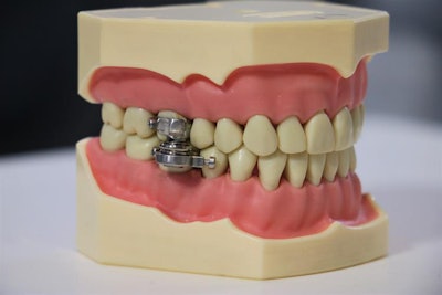 The DentalSlim Diet Control weight-loss device. Image courtesy of the University of Otago.