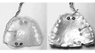 Top and bottom view of the retainer containing the electrodes for intraoral electrical stimulation. Image and caption courtesy of Hangue Park, PhD, of Texas A&M Engineering.