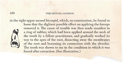 An excerpt and illustration regarding the first reported tooth loss from an elastic band, published in the Dental Cosmos in 1870.