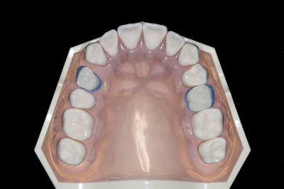 Reapplication of the atraumatic extraction technique with elastic bands over gingivally retained deciduous teeth. All images courtesy of Kravitz et al. Licensed under CC BY-NC-ND 4.0.