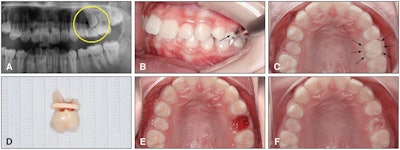 (A) Ectopic maxillary left second premolar and retained baby left second molar. (B) An elastic band (black arrow) was placed interproximally and moved down to the cervical margin. (C) Occlusal view of the elastic band at the time of placement. (D) The extracted deciduous molar with its elastic band still attached. (E) Following tooth extraction by the orthodontist with finger pressure at the seven-day recall appointment. (F) Autonomous eruption of the premolar 14 days after deciduous tooth extraction.