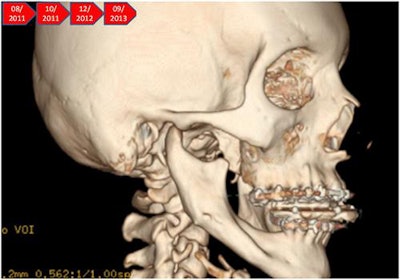 A CT scan of the girl's jaw two years after surgery.