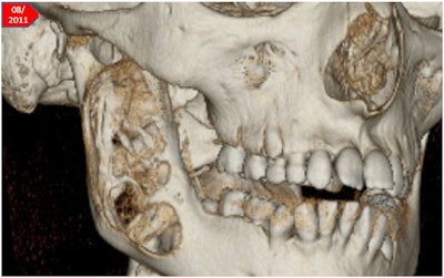 Reconstruction of CT data shows right mandible.