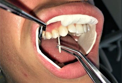 Researchers taking a gingival bacterial sample from a study subject. Image courtesy of Dr. Shatha Bamashmous, University of Washington School of Dentistry.