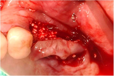 Photo of the patient's mouth immediately after having explantation and flap surgeries at a dental clinic. All images courtesy of Seon et al. Licensed under CC BY-NC-ND 4.0.