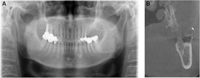 (A) Panoramic radiograph reveals needle fragment located at the anterior ramus of the left mandible. (B) A CBCT image of the lost needle, with two injection needles used as reference points.