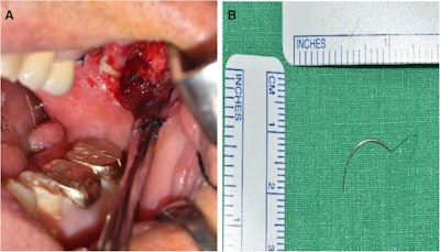 (A) Photo of single needle fragment lodged in the buccal mucosa. (B) The retrieved suture needle.