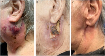 (A) An image of the 75-year-old woman when she presented at the hospital with painful infra-auricular swelling that extended to her neck. (B) The woman, who was treated for a parotid abscess, when she was discharged from the hospital following a 15-day stay. (C) The patient four months after her procedure. All images courtesy of Pruijn et al. Licensed under CC BY-NC-ND 4.0.