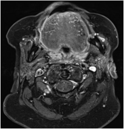 The 75-year-old woman's head and neck MRI scan showed a healed cutaneous tissue defect, parotid gland atrophy, and no signs of malignancy.