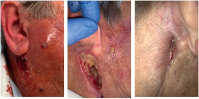 (A) An image of an 81-year-old woman when she presented at the hospital with painful preauricular swelling on her right side. (B) The woman, who was treated for a parotid abscess, after all drains were removed. (C) The patient three months after her procedure.