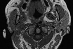2021 08 03 23 11 8351 2021 08 04 Parotid Abscess4 400thumb